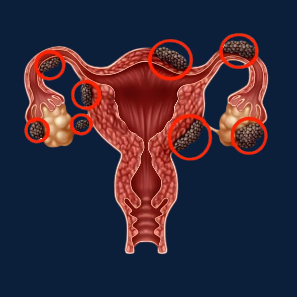A diagram of the womb and ovaries with several patches of endometriosis ringed in red, inside and outside the organs.