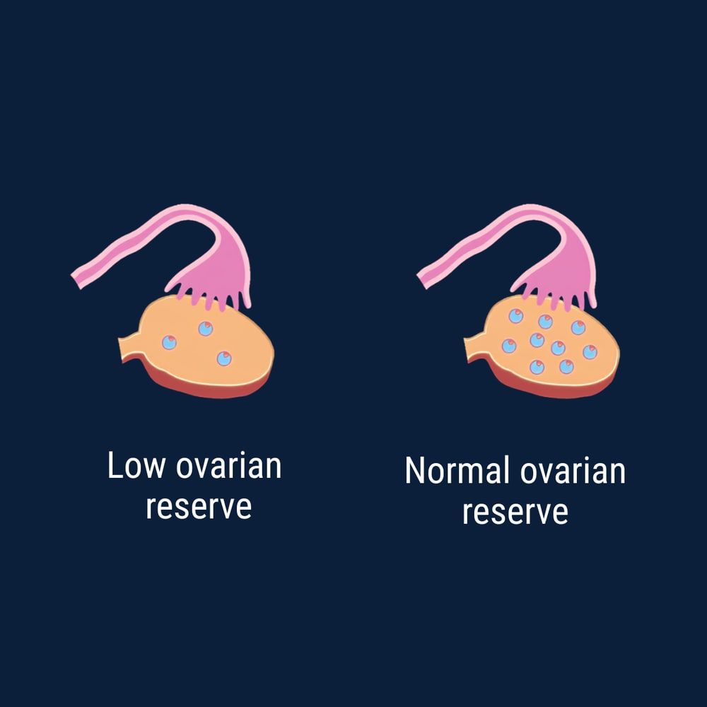 Two ovaries side by side in cross section, one holding a few follicles and the other holding many.